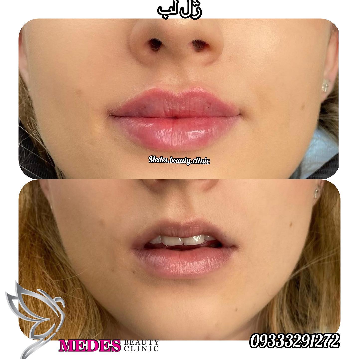 گالری تزریق ژل لب